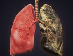 15 Tanda Infeksi pada Paru-paru, Faktor Penyebabnya, dan Cara Pengobatannya