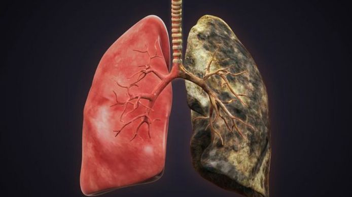 15 Tanda Infeksi pada Paru-paru, Faktor Penyebabnya, dan Cara Pengobatannya (Sumber: Yandex)
